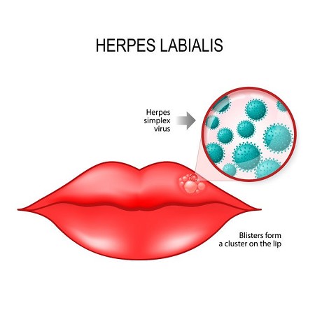 herpes simplex cura | virus dell'herpes simplex | herpes simplex contagio | herpes simplex 1 e 2