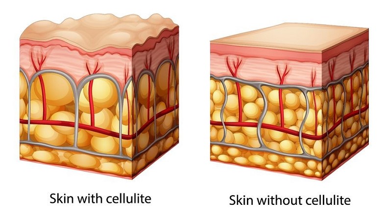 cellulite malattia | cellulite wikipedia | ozonoterapia cellulite recensioni | cellulite esercizi