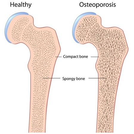 osteoporosis | osteoporosi cause | osteoporosi definizione | osteoporosi cura | osteoporosi valori