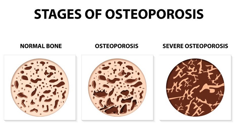 osteoporosi sintomi iniziali | sintomi osteoporosi anca | osteoporosi grave valori |