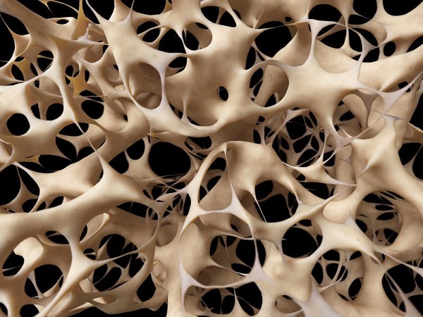 osteoporosi significato | osteoporosi cure naturali | spondilolistesi fisioterapia |