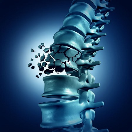 osteoartrite ginocchio | osteoartrite mani | osteoartrite cervicale | osteoartrite spalla |