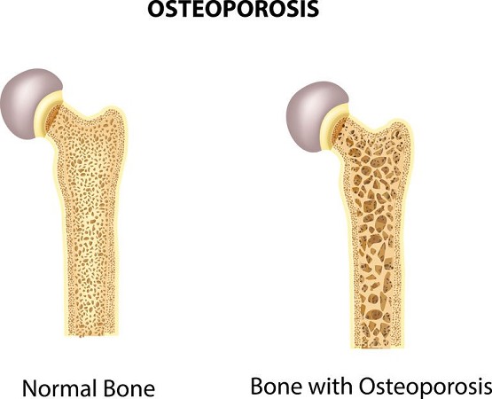 osteoartrite sintomi | osteoartrite sintomi e cure | osteoartrite anca | frattura definizione