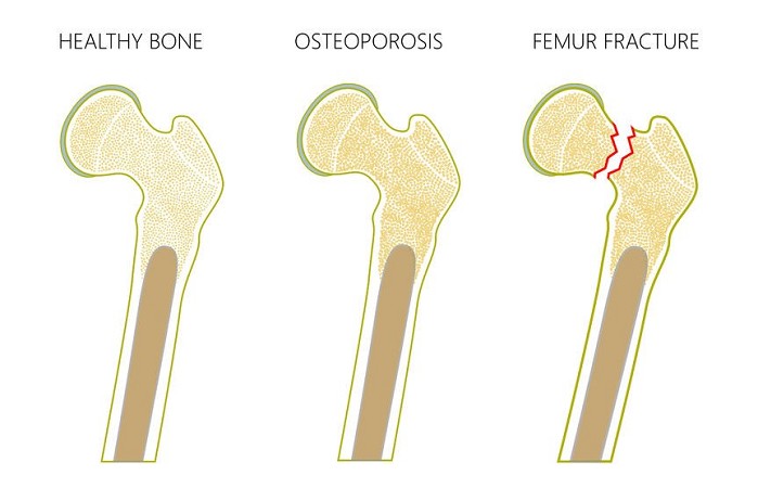 osteopenia cure | osteopenia valori | osteopenia moderata | osteopenia grave | osteopenia e sport