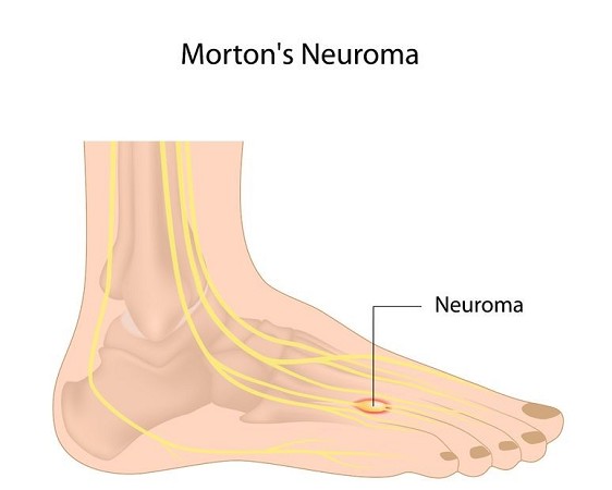 infiltrazioni al piede per neuroma di morton | intervento di neurectomia vestibolare |