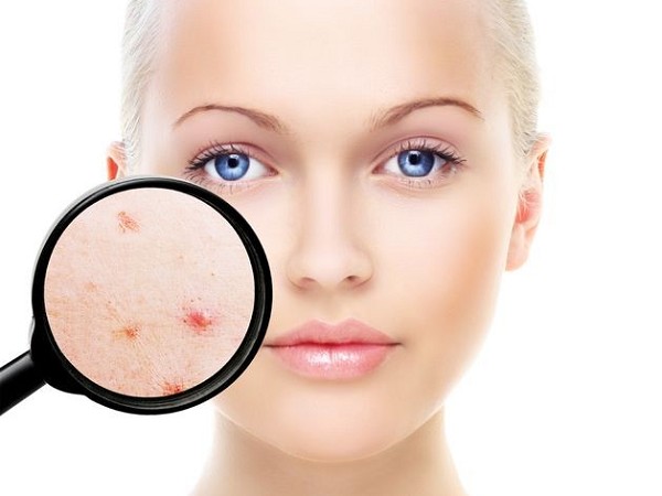 acne tipi | acne cura | acne cause | acne rimedi | acne immagini | acne come curarla
