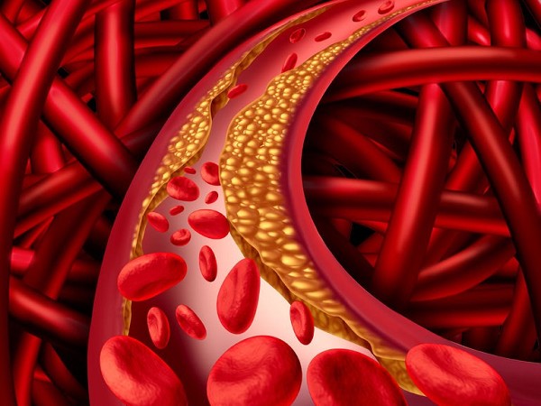 arteriosclerosi e aterosclerosi | arteriosclerosi definizione | ossigenoozonoterapia