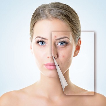 acne giovanile | acne rimedi naturali | acne cause ormonali | acne rimedi | acne come curarla