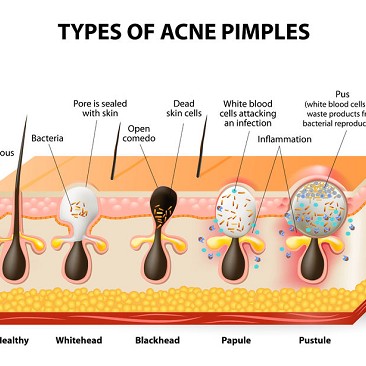 acne giovanile cure efficaci | ossigeno ozono terapia genova | acne ormonale come riconoscerla