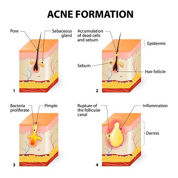 come curare l'acne giovanile | come curare l'acne tardiva | come curare l'acne in modo naturale