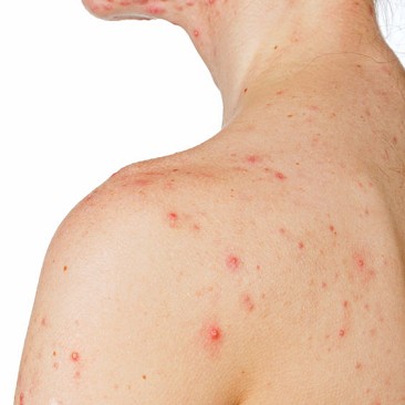 acne e comedoni bianchi | brufoli con pus | come far sparire i brufoli | acne grave | acne tardiva