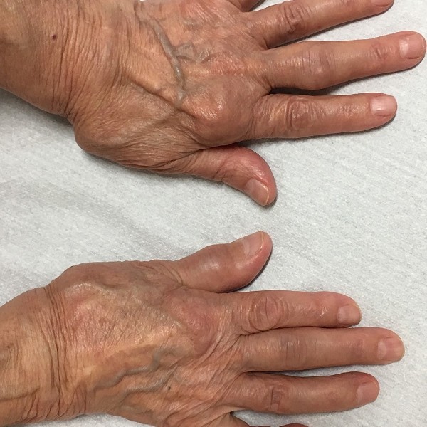 artrite reumatoide mani | artrite reumatoide cure | artrite reumatoide sintomi iniziali